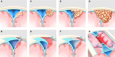 Efficacy and safety of a “radical” surgical strategy in the treatment of parasagittal sinus meningioma